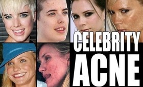 CELEBRITIES WITH ACNE!!!!