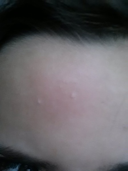 Odd Bumps On my Forehead! :O. | Beautylish