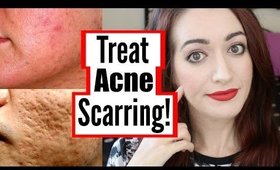 How To Treat Mild, Moderate And Severe Acne Scarring!