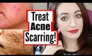 How To Treat Mild, Moderate And Severe Acne Scarring!