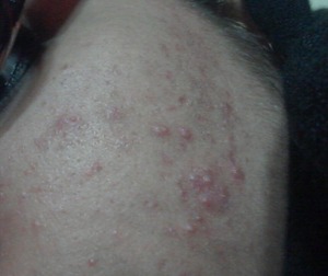 got them on both cheeks and forehead. what should i do? :'( has been a month now. my skin is too oily.