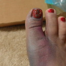 Bruised Toe 