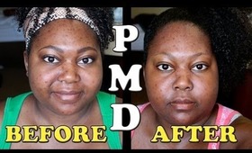 PMD (Personal Microderm) Review and Demo