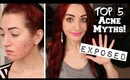 TOP 5 ACNE MYTHS EXPOSED! The Truth About Acne!