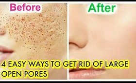 How To Treat Large Open Pores Naturally At Home Remedies |SuperPrincessjo