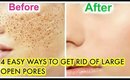 How To Treat Large Open Pores Naturally At Home Remedies |SuperPrincessjo