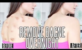 How To Get Rid OF BACK ACNE OVERNIGHT !!