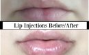 LIP INJECTIONS | My Experience + Before/After Photos