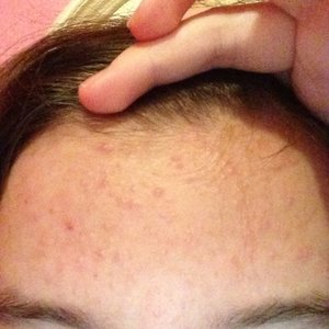 Can shampoo cause acne breakouts? | Beautylish
