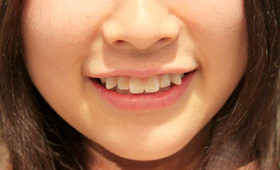 Japan’s Latest Beauty Trend: Paying Money To “Ruin” Your Teeth