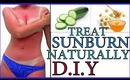 How To Treat Sunburn Fast Naturally at Home ,Hyperpigmentation Sunburn Natural Fast Treatment