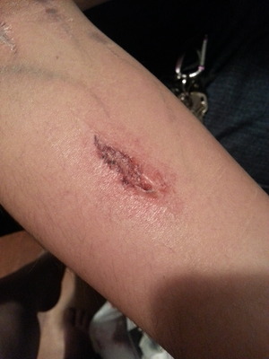 You can see the bottom of the track marks, and then the gash in the arm.