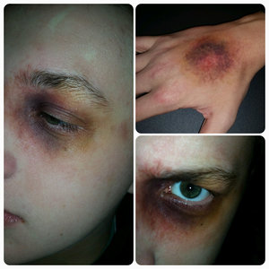 Realistic bruise and black eye makeup. Visit my Facebook for more regular updates and more images! www.Facebook.com/emilyjaynemakeup
