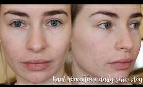 FINAL ROACCUTANE DAILY SKIN VLOG - MONTH 8