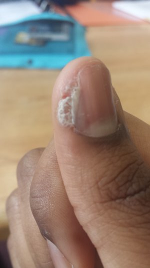 There is a lot of dead skin around my nail bed and so my nail grows with a streak of permanent yellow. I'm not sure how I can fix this and better my nail.