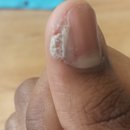 Whats wrong with my nail growth?