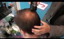Hair Thinning on the Crown