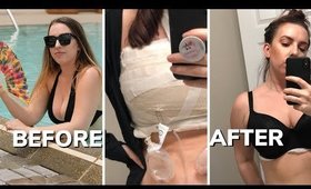 BREAST REDUCTION RECOVERY: 1 MONTH UPDATE, SCARS, PAIN, HEALING PROCESS