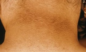 Hindi Video _ Dark Neck Remedy | How to Get Rid of Dark Neck, Make Neck Fair  _ SuperWowStyle