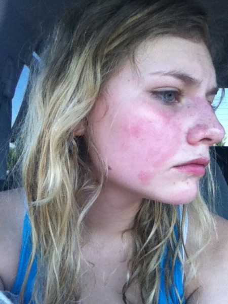 help-my-skin-is-red-blotchy-and-dry-beautylish