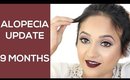 Alopecia Update 9 Months