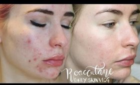 Roaccutane Daily Skin Vlog - Month 5