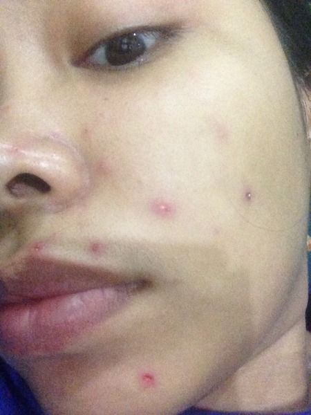 Is applying makeup over your chicken pox okay? | Beautylish