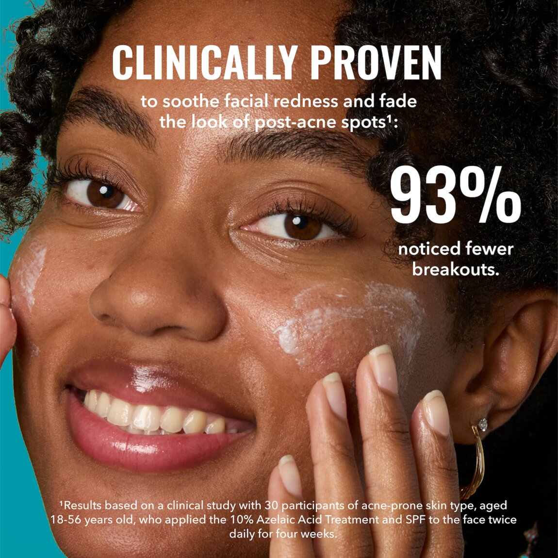 10% Azelaic Acid Treatment 30ml - Duo, Reduces Redness and Dark Spots from Pimples or Sun Damage, For Oily or Acne-Prone Skin