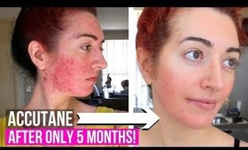 Accutane Side Effects + Mental Health Questions | Month 5 Update | Jess Bunty