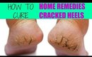 How To Treat CRACKED HEELS At Home | SuperPrincessjo