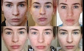 5 MONTH ROACCUTANE UPDATE - Side Effects & My Skin Now