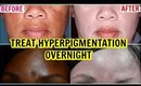 How To Treat Hyper Pigmentation Naturally Over Night | SuperPrincessjo