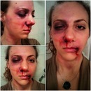 beaten up face