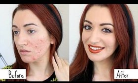 Easy Acne & Scarring Coverage GRWM // How To Cover Acne Makeup Transformation