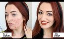Easy Acne & Scarring Coverage GRWM // How To Cover Acne Makeup Transformation