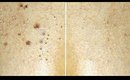 Dark Spot Removal _ Home Remedy For Black Spots on Face |  SuperWowStyle Skin Care