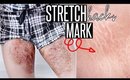 HOW TO GET RID OF STRETCH MARKS Naturally + Fast | DIY Stretch Mark Removal