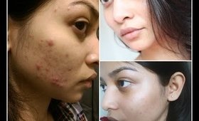 How I cured my acne || Makeover Obsession ||
