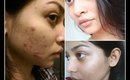 How I cured my acne || Makeover Obsession ||