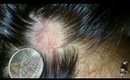 Alopecia Areata (Autoimmune Disease) ?!?