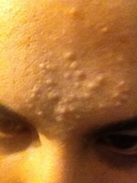 Really Bad!! Acne? Pimples.. | Beautylish