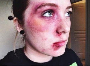 First attempt at a black eye, fat lip, and other bruising.