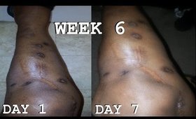 Lactic Acid:Fading Surgery Scars | Week 6 | Demo + Result Pics