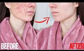 How To Get Clear Skin FAST ! The REAL WAY !