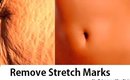 How to Get Rid of Stretch Marks _ Naturally & Fast _ Home DIY _ (Superwowstyle Prachi)