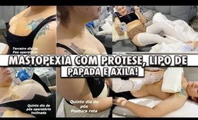 Pós Operatório: MASTOPEXIA COM PROTÉSE E LIPO DE PAPADA E AXILA - 1 Semana! | Duda Fernandes
