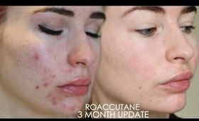 3  MONTH ROACCUTANE UPDATE - Side effects & my skin now