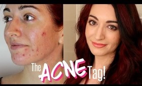 THE ACNE TAG & My Acne History | DiamondsAndHeels14 & Daiserz89