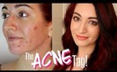 THE ACNE TAG & My Acne History | DiamondsAndHeels14 & Daiserz89