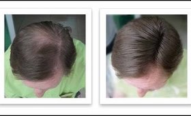 Male Pattern Baldness (1.3)